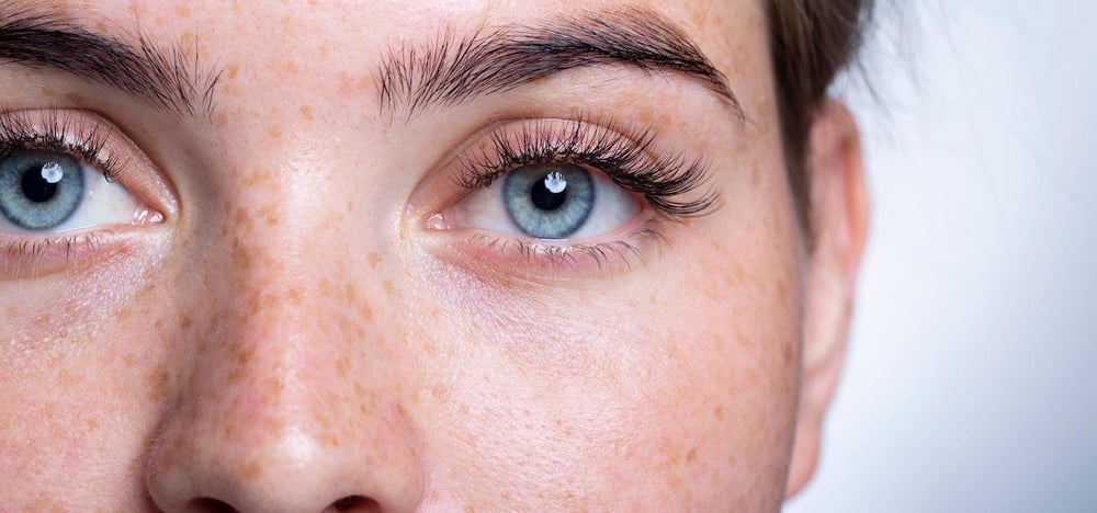 علاج التصبغ في دبي