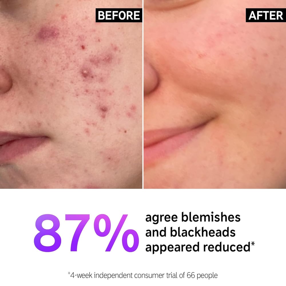 gentle skin cleanser for oily skin