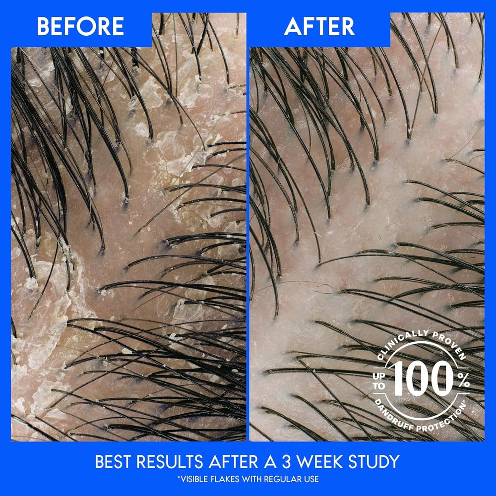 medicated dandruff shampoos