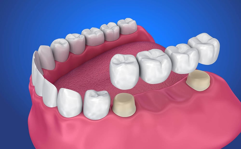Dental Crowns and Bridges in Dubai