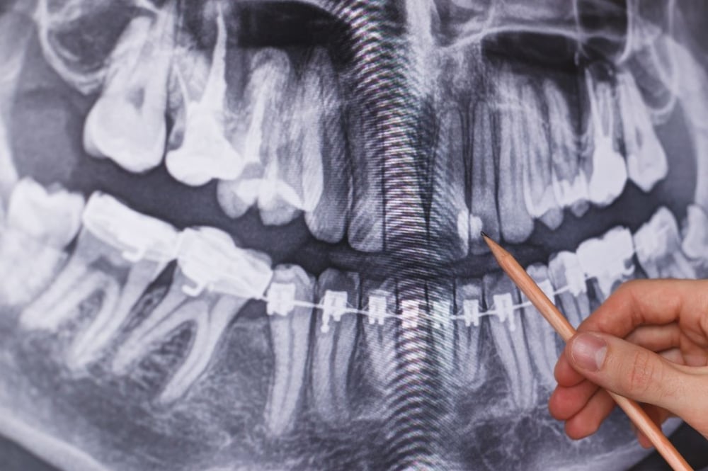 Panoramic Dental X-Ray Cost in Dubai