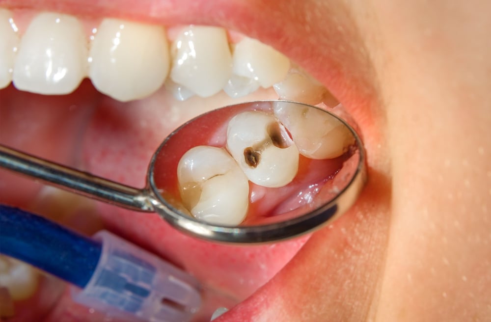 Tooth Filling Cost in Dubai