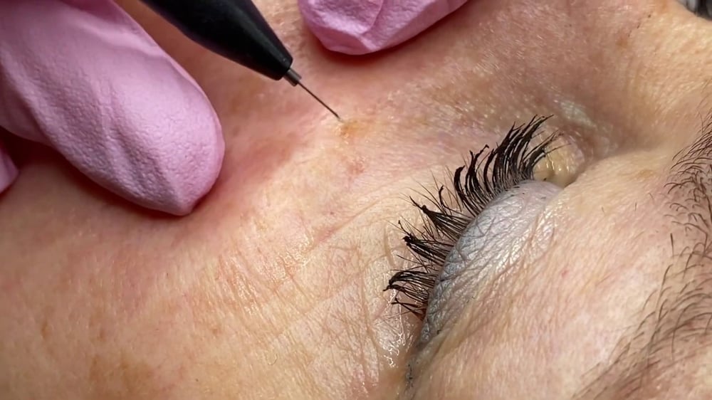 Skin Wart Removal Cost in Dubai