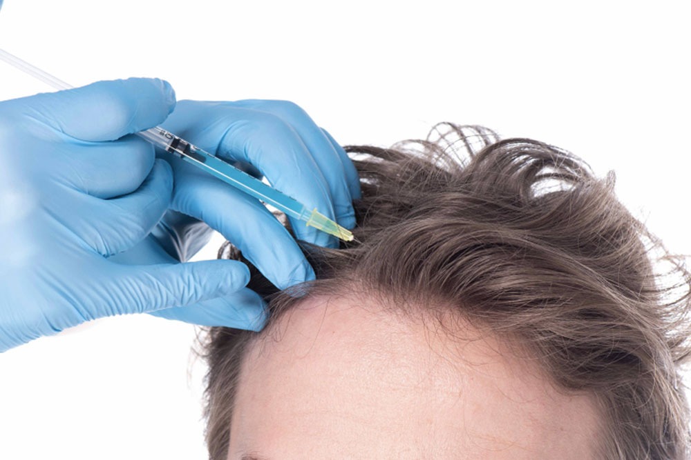 Best PRP Hair Treatment in Dubai