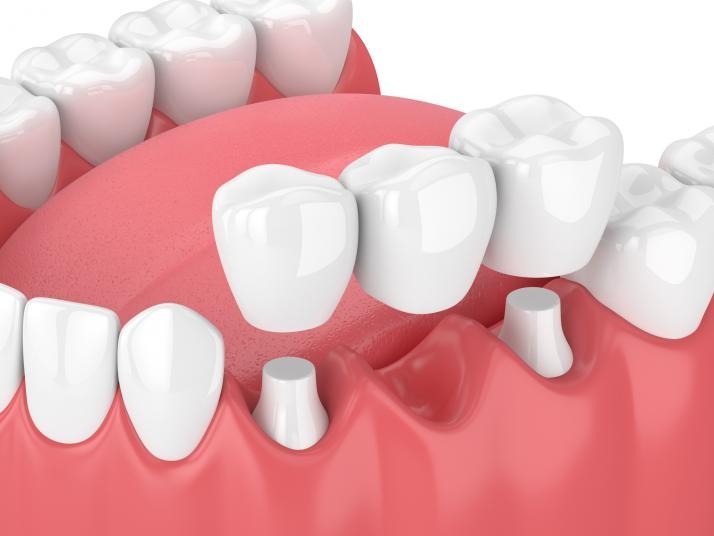 Dental Crowns and Bridges in Dubai