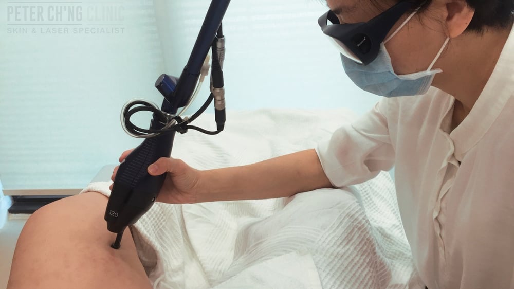 Laser Stretch Marks Treatment in Dubai