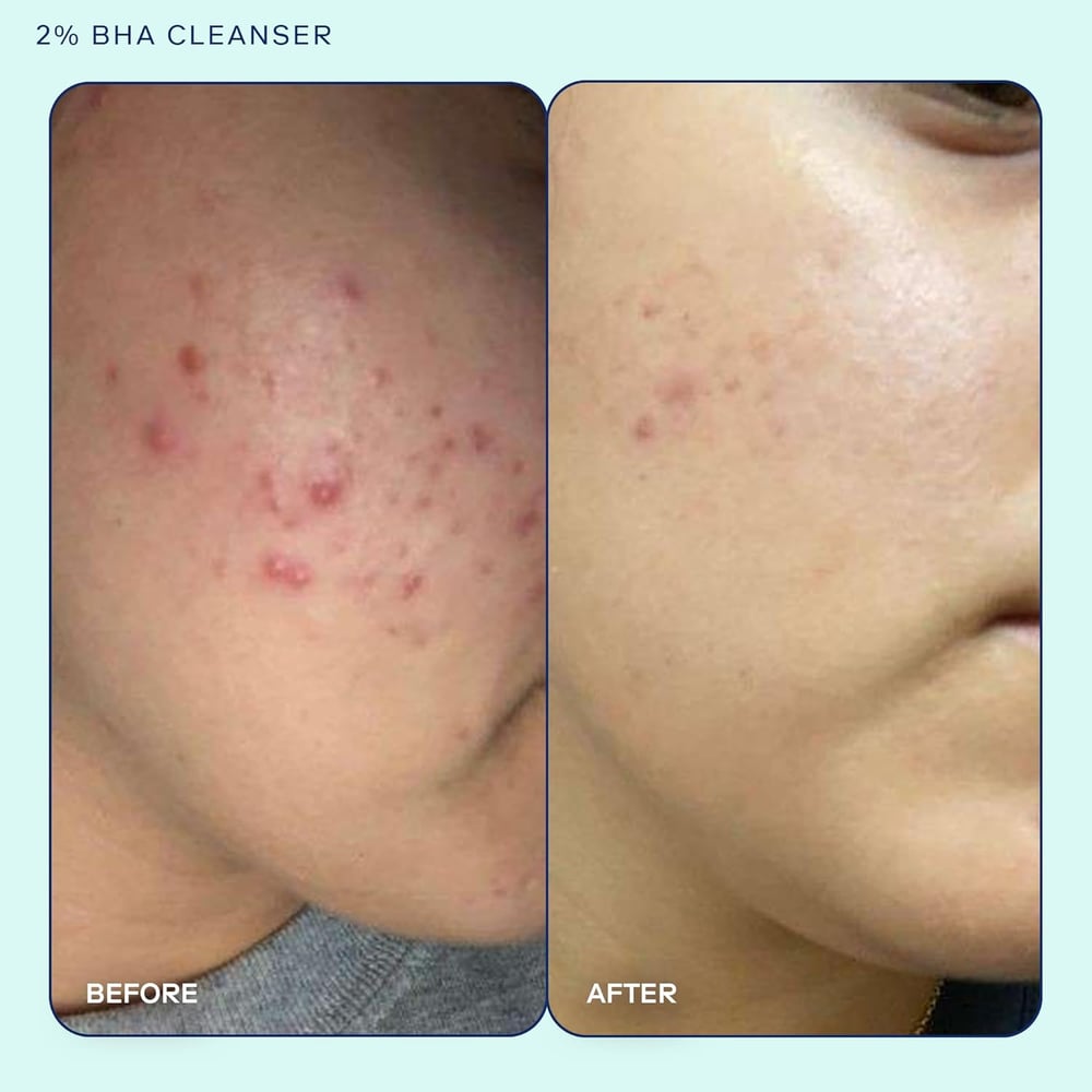 salicylic acid cleanser for blackheads