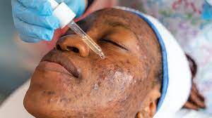 Chronic acne consistent with PCOS