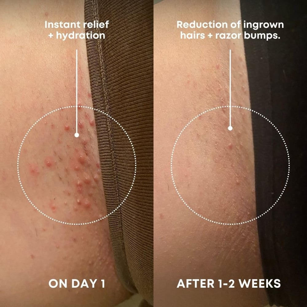 ingrown hair exfoliator