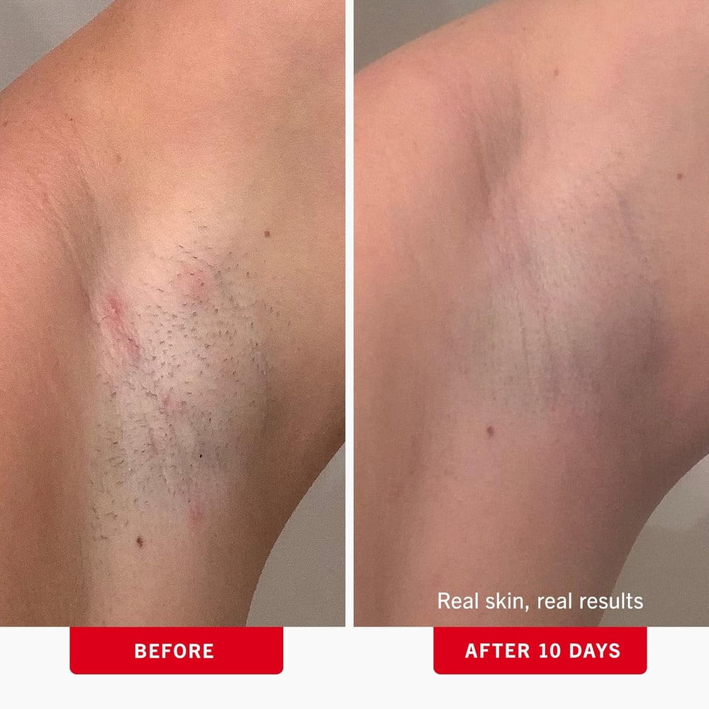 ingrown hair scrub