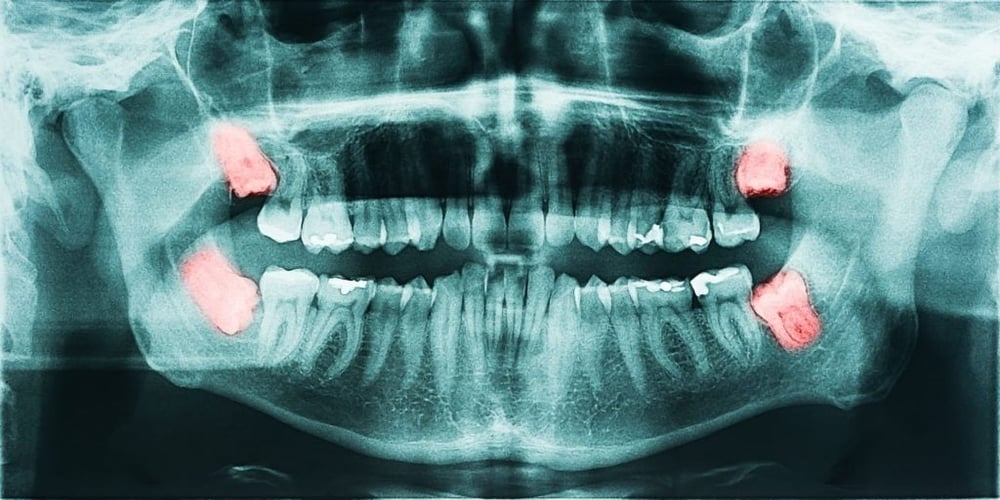 Panoramic Dental X-Ray