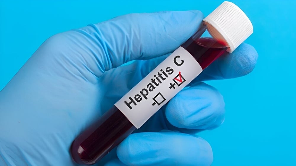 Hepatitis C Test in Dubai