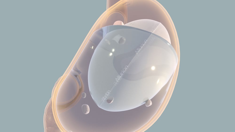 Allurion Balloon for Weight Loss
