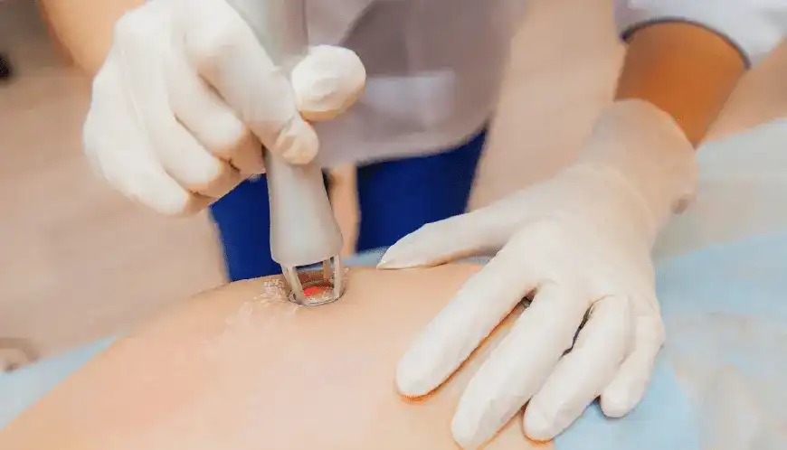 Laser Stretch Marks Treatment