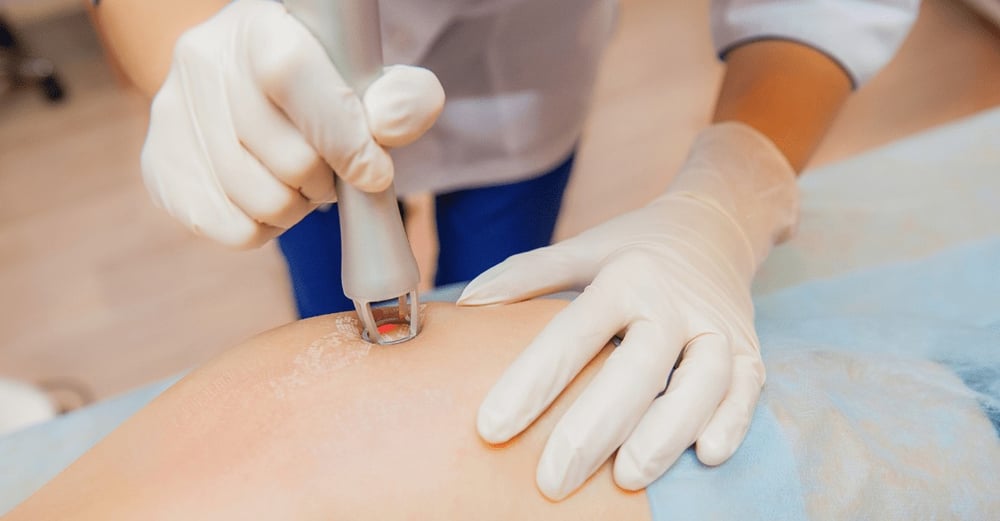 Laser Stretch Marks Treatment