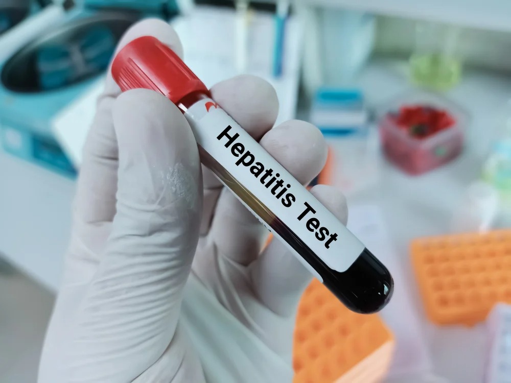 Hepatitis C Test