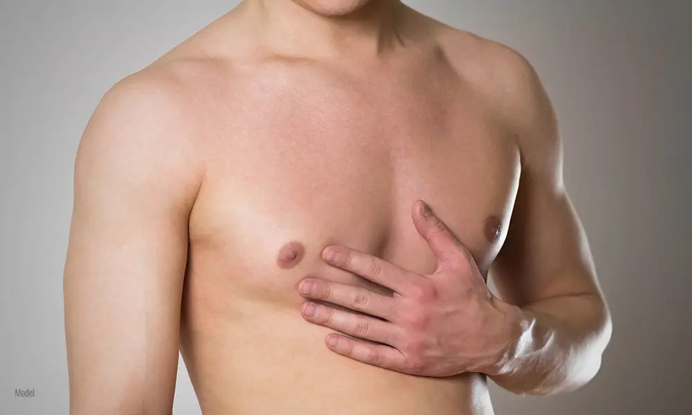 Gynecomastia