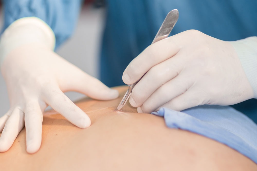 Skin Tag Removal in Dubai