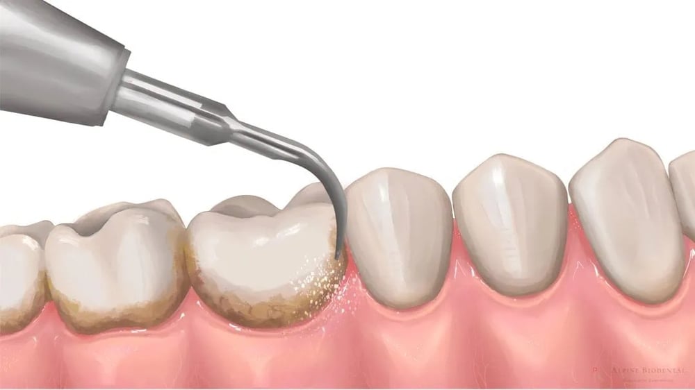 Teeth Cleaning in Dubai