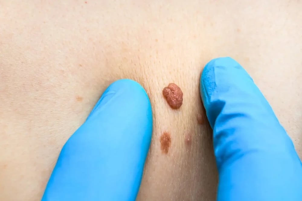 Skin Tag Removal in Dubai