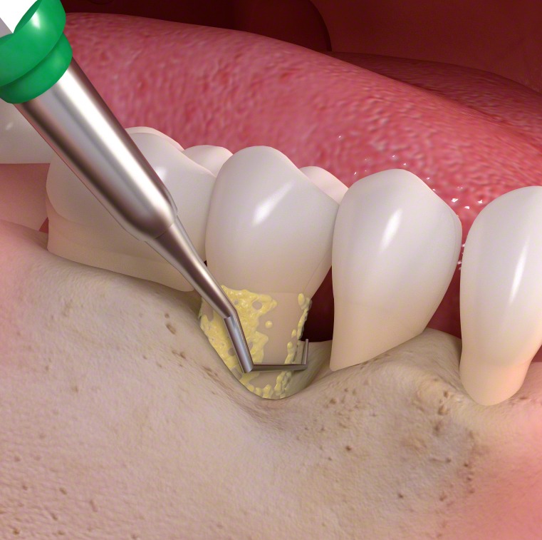 Teeth Cleaning in Dubai