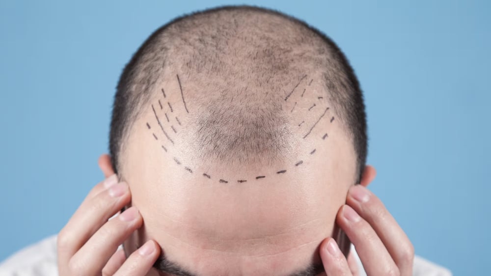 Scarless Hair Transplant in Dubai