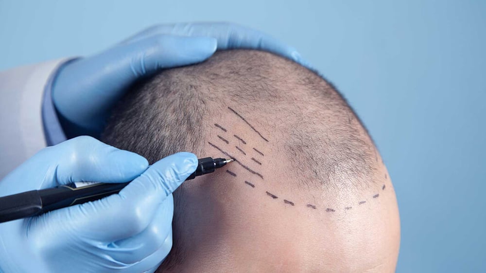 Scarless Hair Transplant in Dubai