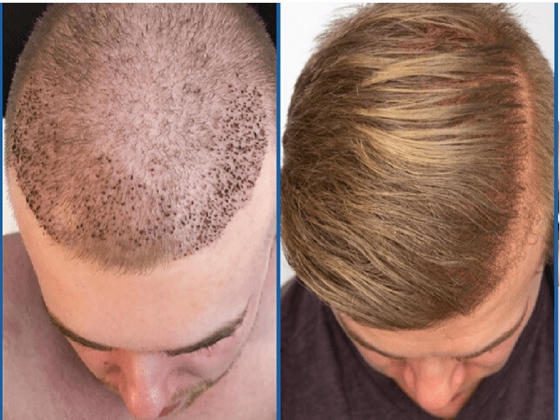 Scarless Hair Transplant in Dubai