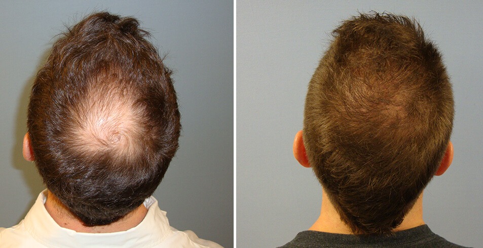 Scarless Hair Transplant in Dubai