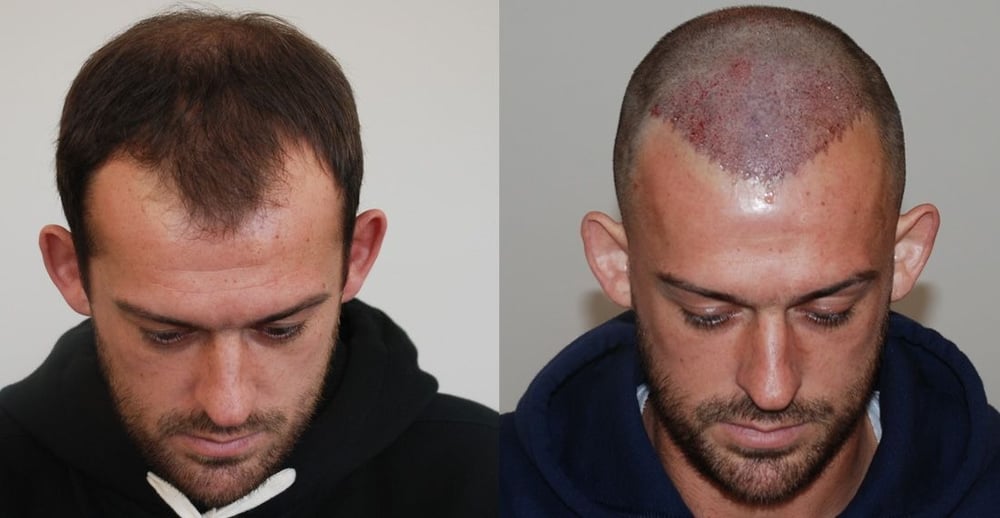 Scarless Hair Transplant in Dubai