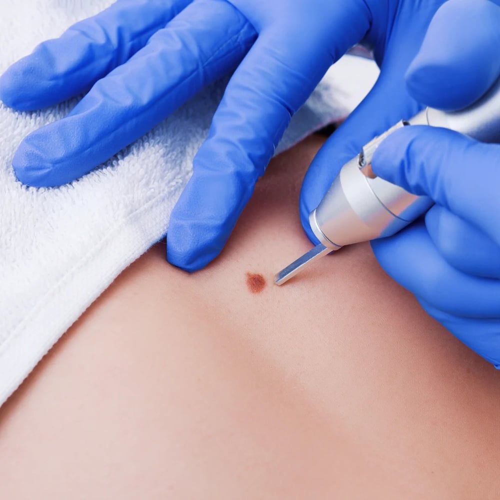 Skin Tag Removal in Dubai