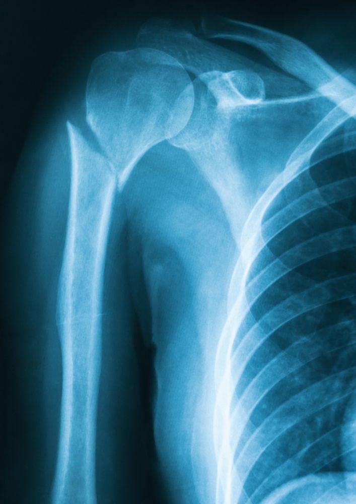 Fractura del hueso mero en una radiografíahú