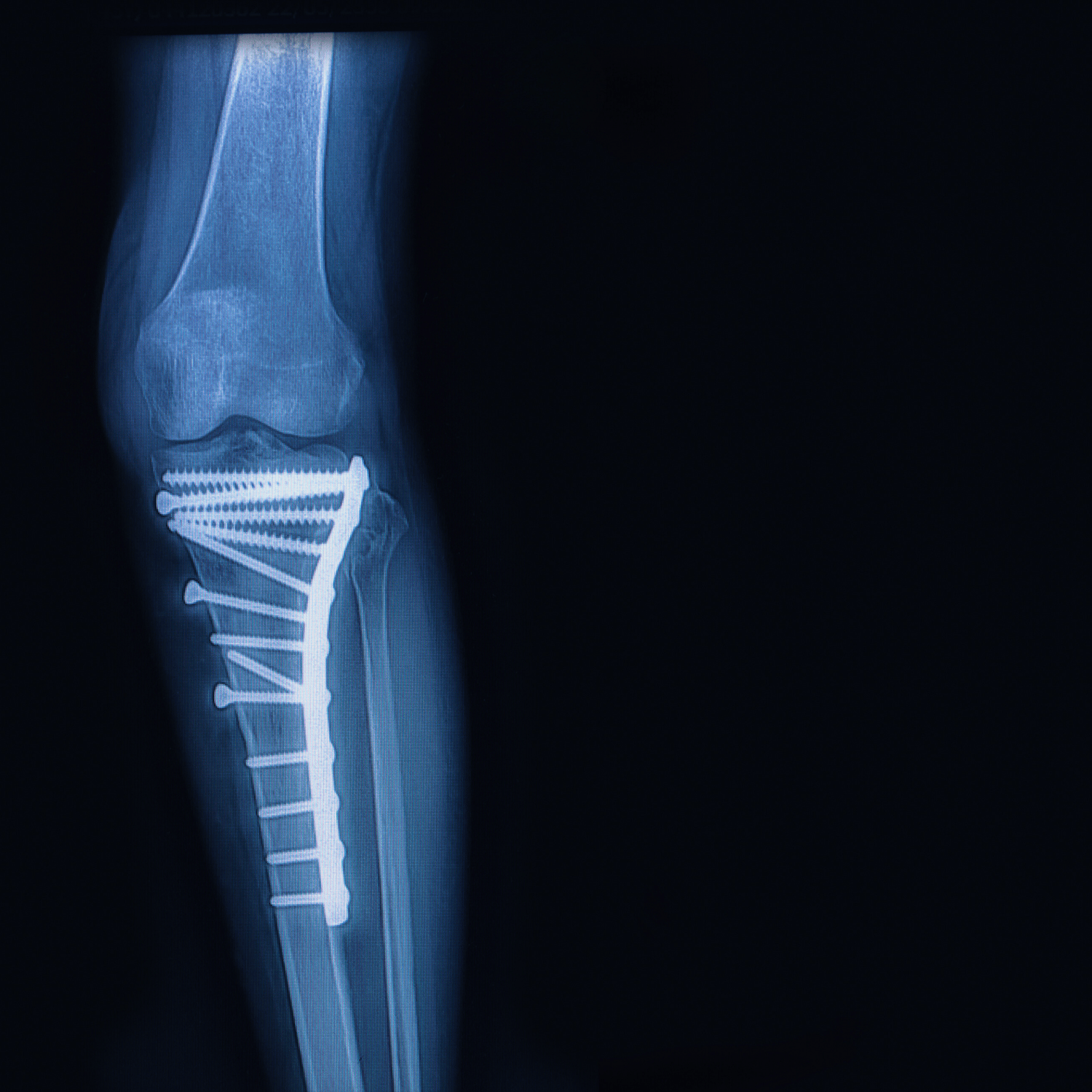 Tibia fracture, Surgical repair