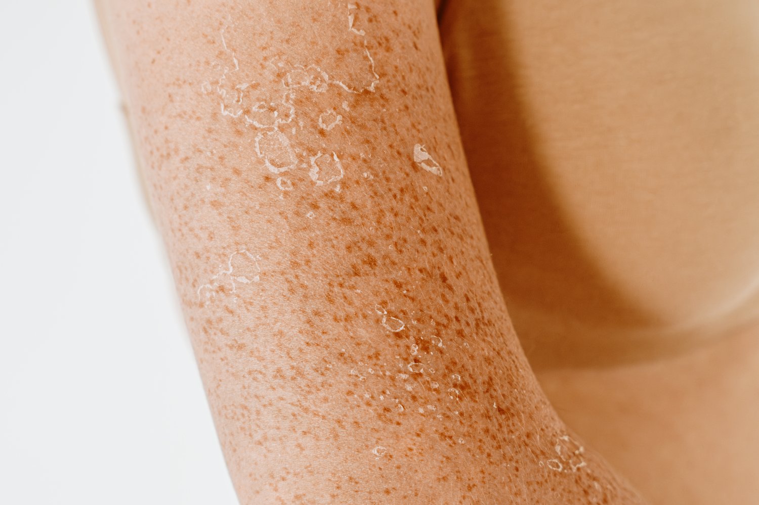 moisturiser for peeling skin