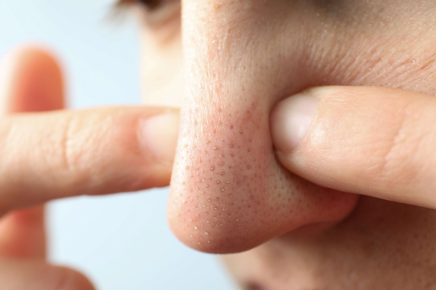 A close-up of a person squeezing the skin on their nose with their fingers, showing visible pores and blackheads—a reminder of why using a salicylic acid cleanser for blackheads can help keep pores clear.