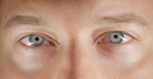 Eyelid Surgery in Riyadh