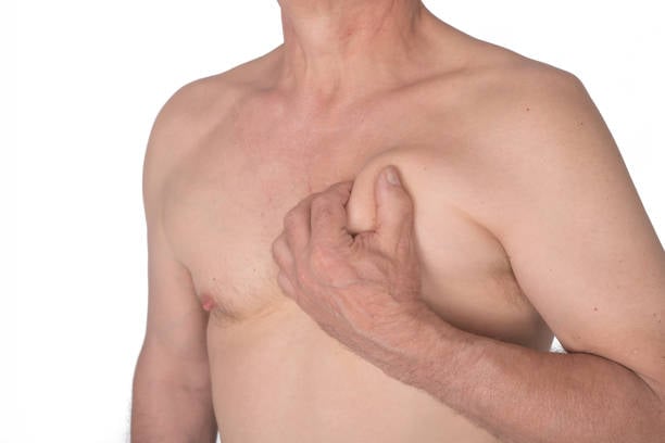 جراحة التثدي في الرياض