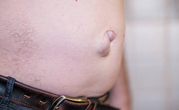 تكلفة جراحة الفتق في الرياض