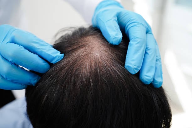 Exosomes Therapy for Hair Loss in Riyadh