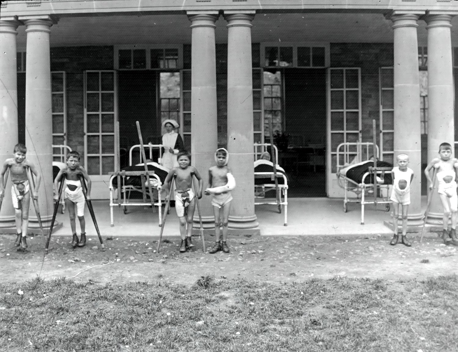 A staged photo showing some boys in bed on the veranda and other boys standing in a plaster Thomas splint, mainly using crutches. The child’s unaffected leg was fitted with a patten to stop the child from inadvertently putting weight on the tubercula joint. One boy has his arm in plaster.