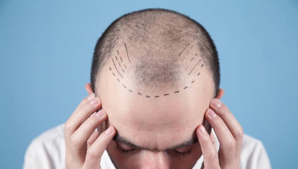 Hair Transplant Cost in Riyadh