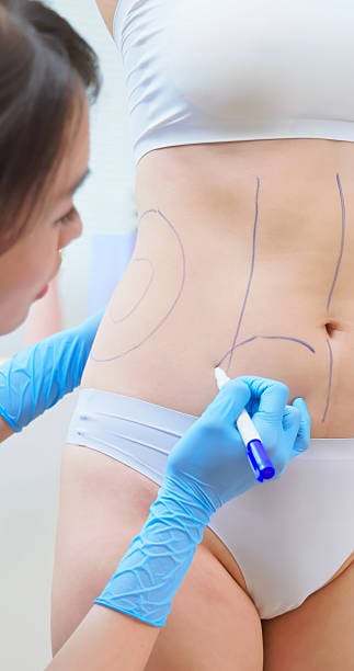 شفط الدهون في الرياض