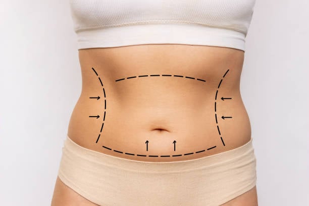 Liposuction in Riyadh