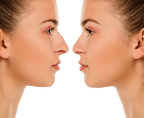 Rhinoplasty in Riyadh
