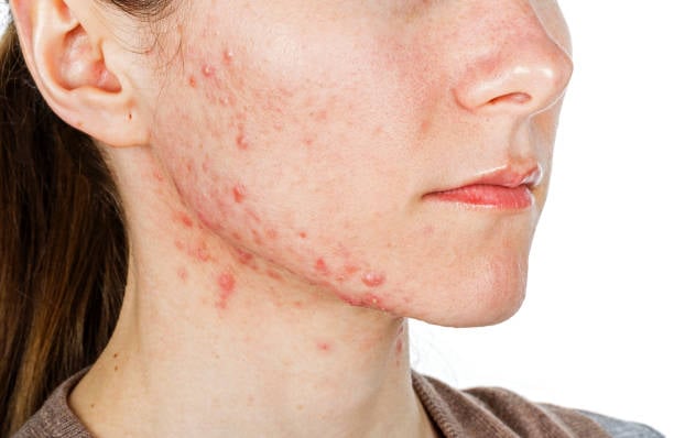 Pimples Treatment in Riyadh