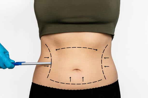 360 Liposuction in Riyadh