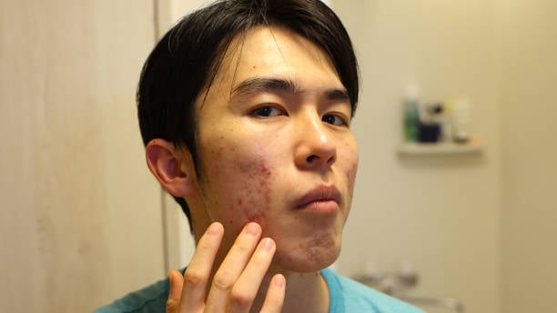 Pimples Treatment in Riyadh