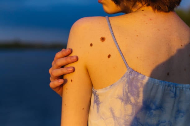 إزالة الشامة في الرياض