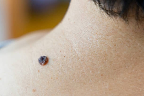 عملية إزالة الشامة في الرياض