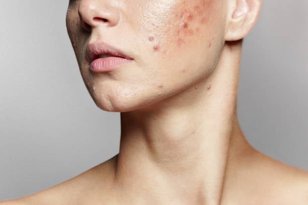 Pimples Treatment in Riyadh